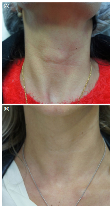 What Treatments Go Well with Ultherapy...? / Radiesse Collagen Booster image 4