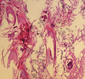 Juvéderm? Ultherapy? Introducing Radiesse, a New Collagen Booster, Part 1 / Gangnam Sinsa Station Dermatology Clinic image 7