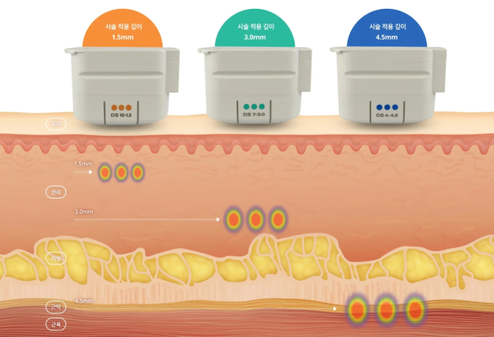리프톤 피부과 울쎄라피 프라임 & 써마지 추가 도입 관련 이미지 3