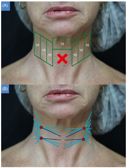 What Treatments Go Well with Ultherapy...? / Radiesse Collagen Booster image 2
