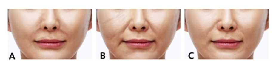 신사 팔자주름 N-Scaffold를 활용한 구조적 개선｜2025 PENTA-A 강연 후기 관련 이미지 4