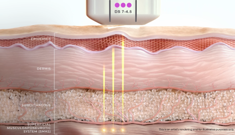 What Has Changed in the Effects and Pain of Ultherapy Prime? image 5