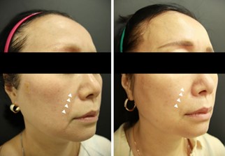 Lifting That Can Replace Ulthera and InMode: TION Lifting (Titanium + ONDA Lifting) image 3