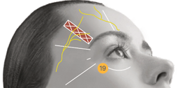 Ultherapy Prime: Facial Sagging Appears Differently Depending on the Area image 9