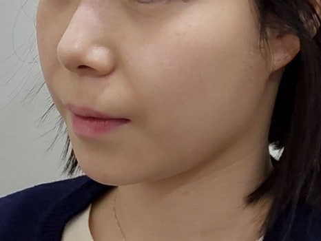 People Who Absolutely Should Not Get Thread Lifting! Who Should Get It?/Sinsa Station Dermatology image 2