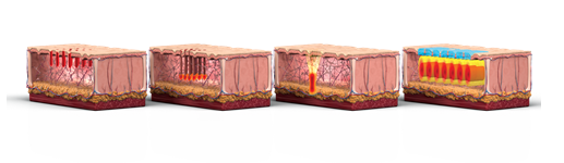 Sinsa SOFWAVE | Official Introduction at Lifton Dermatology Clinic image 3