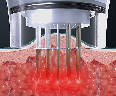 How to Reduce Pores image 4