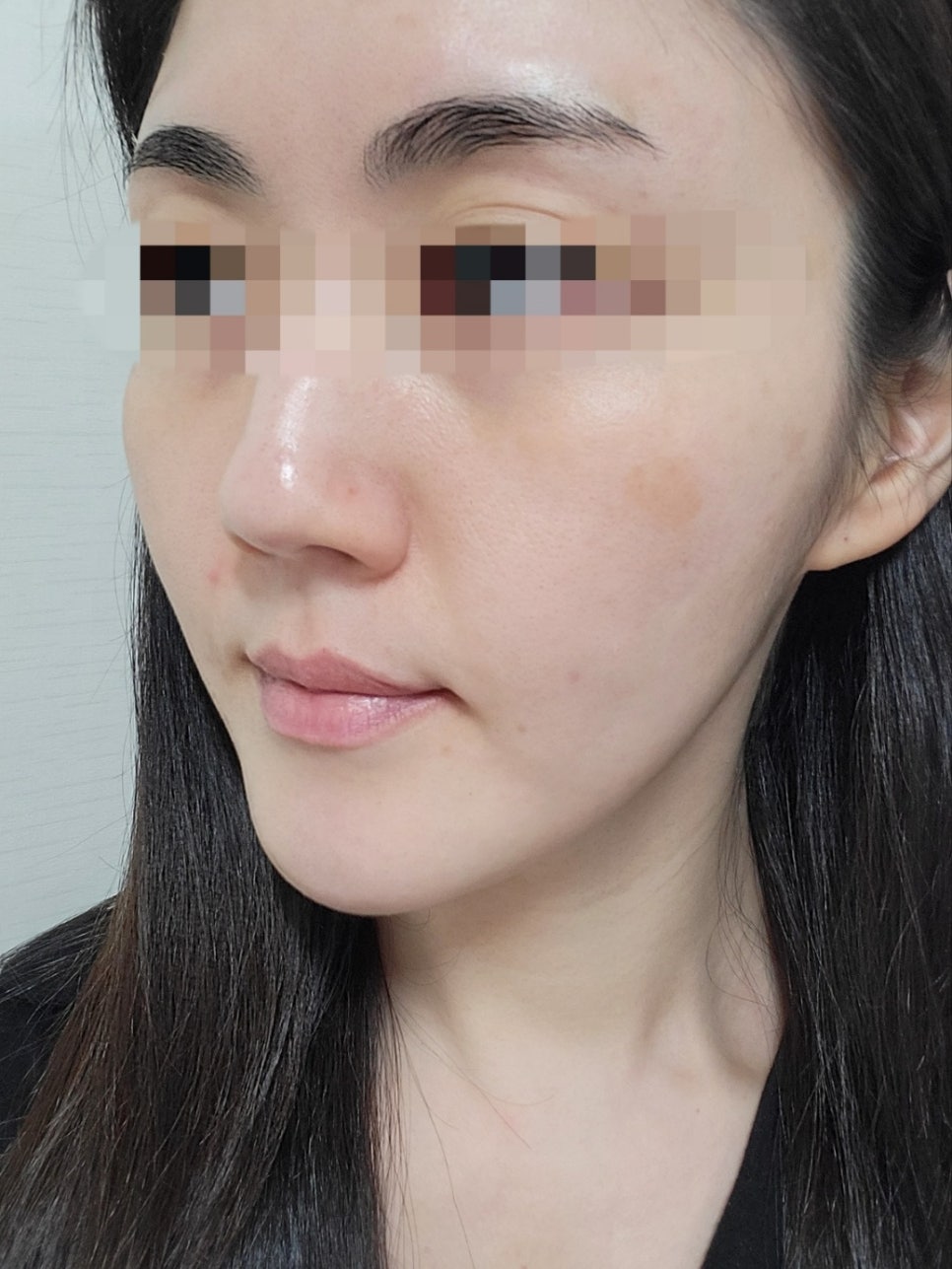 리쥬란과 물광주사를 하나로 합친 스킨부스터가 있다?(리쥬란 실제효과,르네힐러)/ 강남 신사동 피부과 관련 이미지 11