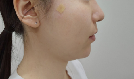 What Is MD Codes Filler? Why It Looks Naturally More Youthful image 7