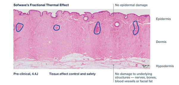 At What Stage Is Shinsa Sofwave Considered? image 6