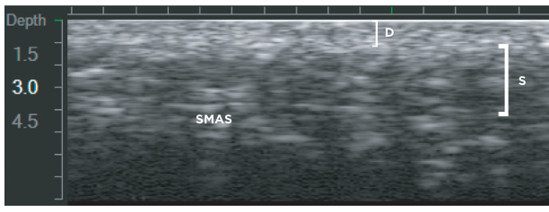 The Number of Ultherapy Shots That’s Right for Me, Explained by an Ultherapy Key Doctor image 3
