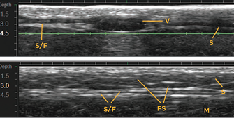 Ultherapy Prime: Facial Sagging Appears Differently Depending on the Area image 3