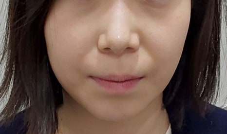 People Who Absolutely Should Not Get Thread Lifting! Who Should Get It?/Sinsa Station Dermatology image 1