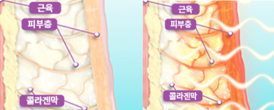 울써마지 결과가 달라지는 얼굴 층별 설계 관련 이미지 2