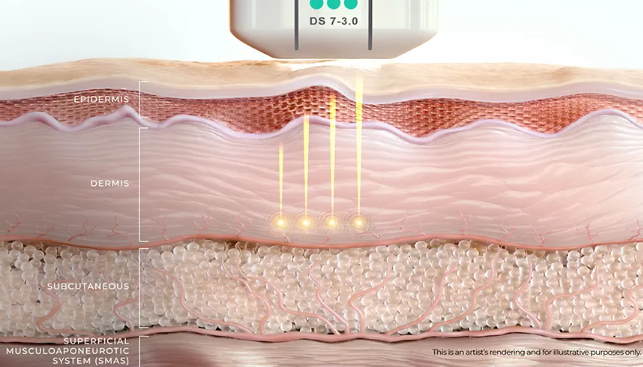 LeapTone Dermatology Clinic, First in Korea to Adopt the Upgraded Ultherapy PRIME image 4