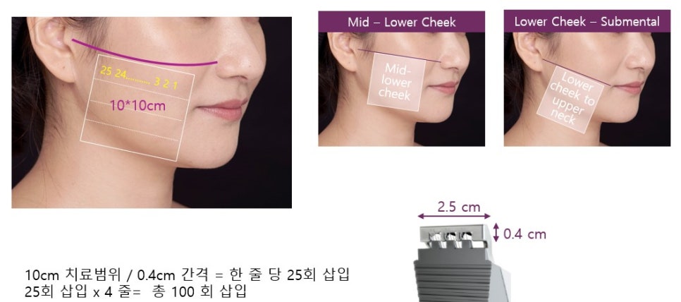 프로파운드 리프팅 받기전 무조건 읽어보세요. / 강남 신사역 피부과 관련 이미지 4