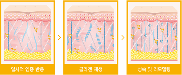 소프웨이브&middot;울쎄라를 함께 하는 이유｜ 신사 소프쎄라가 필요한 얼굴 관련 이미지 3