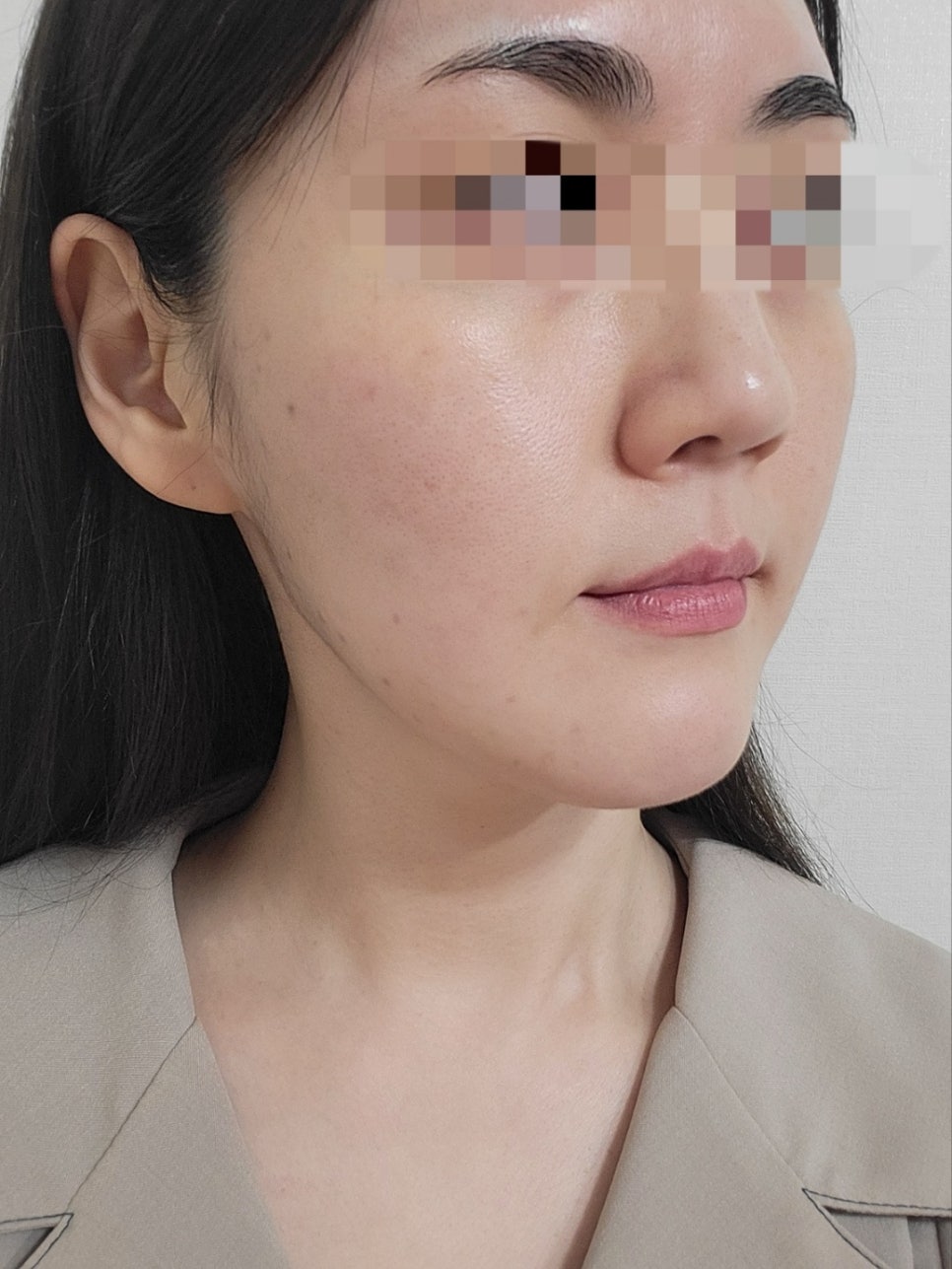 리쥬란과 물광주사를 하나로 합친 스킨부스터가 있다?(리쥬란 실제효과,르네힐러)/ 강남 신사동 피부과 관련 이미지 8