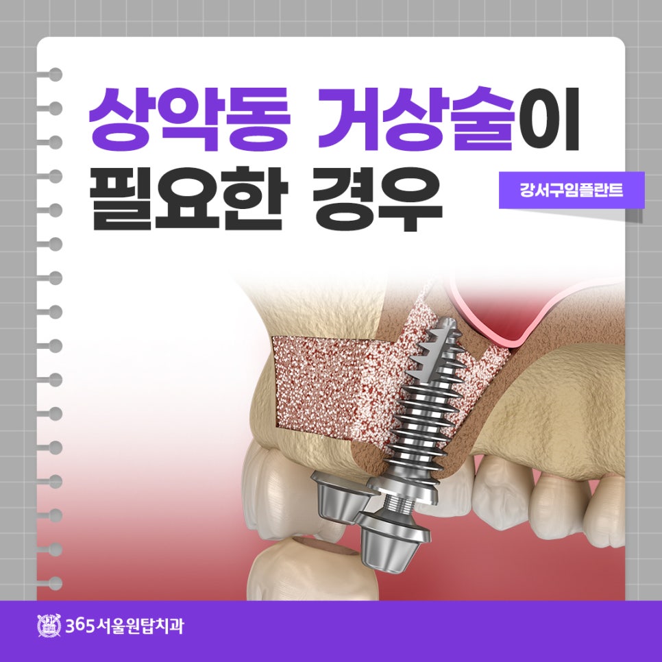 강서구임플란트, 상악동 거상술이 필요한 경우 관련 이미지 14