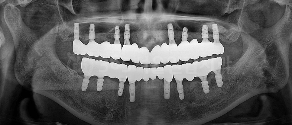 원종동치과 임플란트, 치과공포증이 있어도 가능한 이유 관련 이미지 4