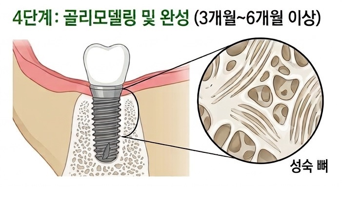강서구 임플란트치과 , 임플란트 뼈이식이 자리를 잡기까지 관련 이미지 6