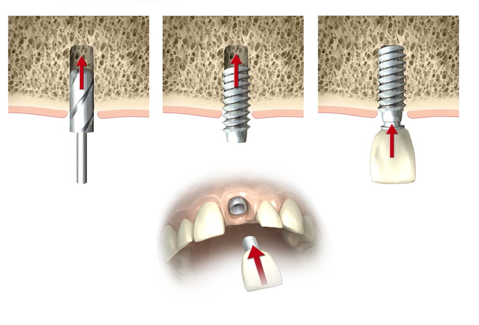 강서구 365치과, 원데이 임플란트의 모든 것 관련 이미지 3