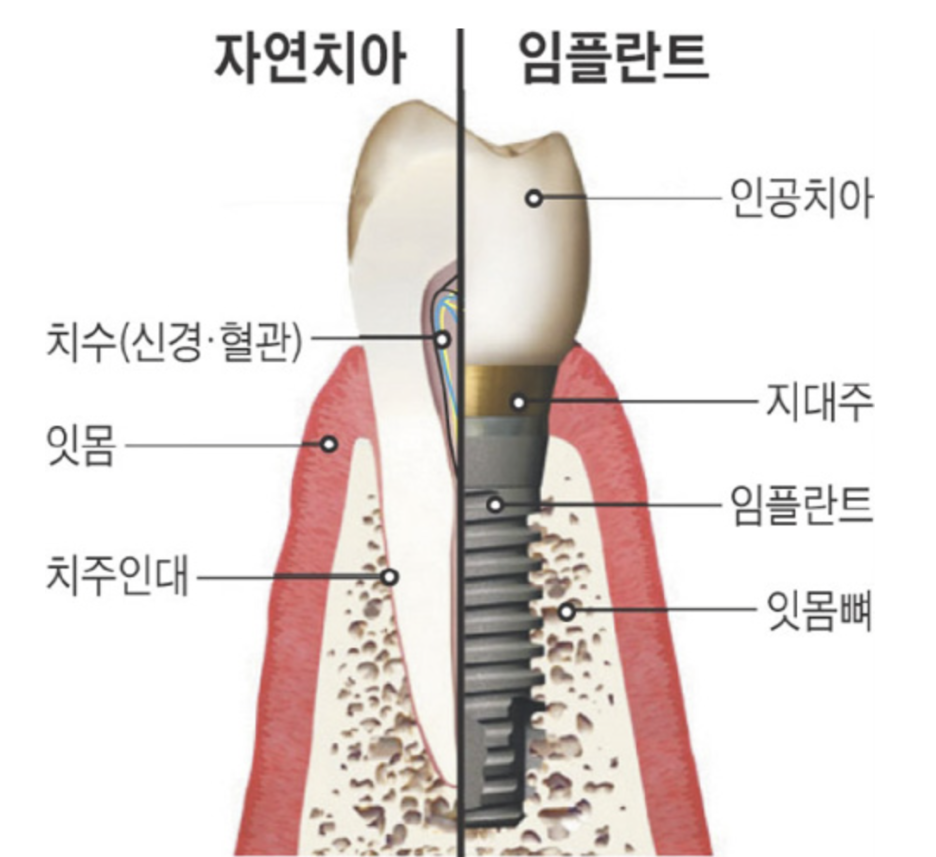 강서구청치과 임플란트 오래 쓰려면 피해야할 이것 관련 이미지 6