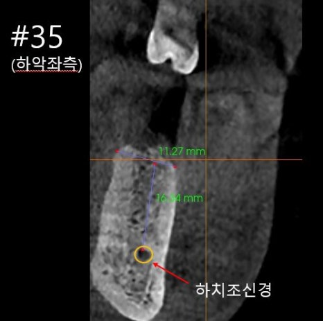 Balsan Station Dental Clinic: What If the Anesthesia Doesn’t Wear Off After Implant Surgery? image 6