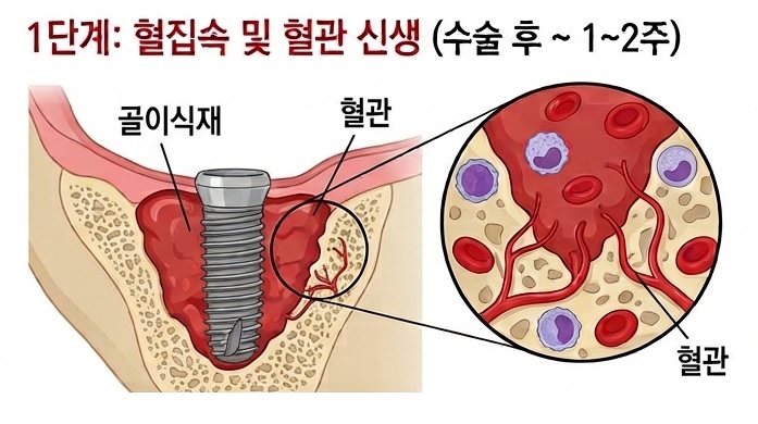 강서구 임플란트치과 , 임플란트 뼈이식이 자리를 잡기까지 관련 이미지 3