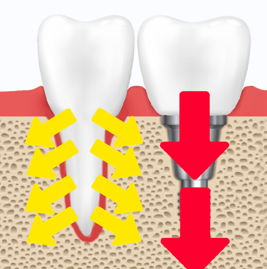 신월동치과 임플란트 심는 자리만 보면 안 되는 이유 관련 이미지 7