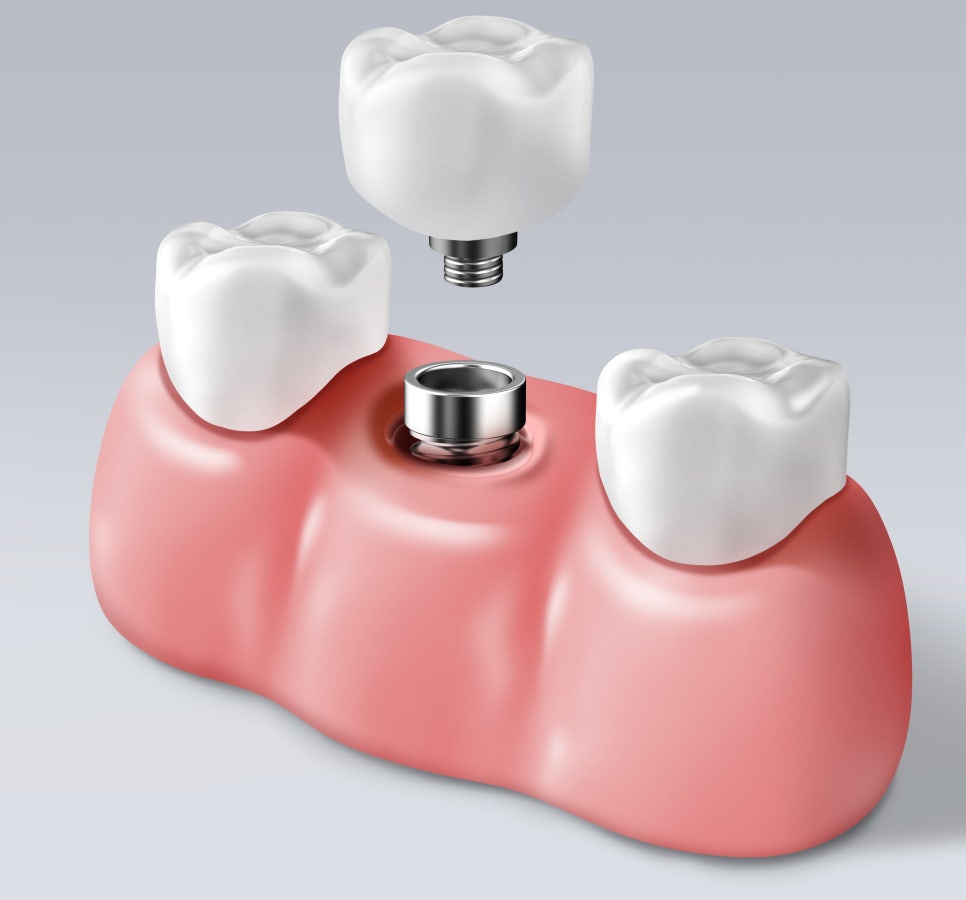 김포공항 근처 치과에서 알아보는 임플란트 vs 브릿지 차이점 관련 이미지 5