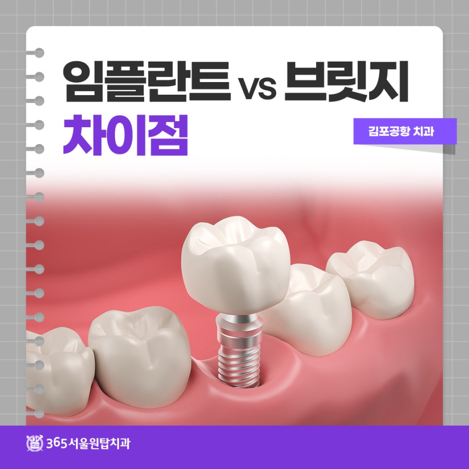 김포공항 근처 치과에서 알아보는 임플란트 vs 브릿지 차이점 관련 이미지 9