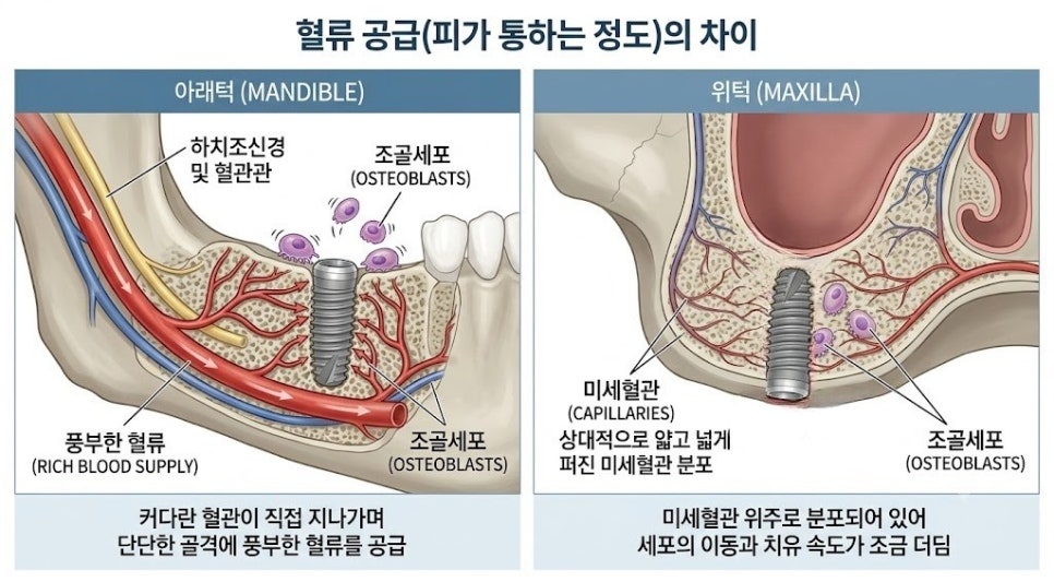 강서구 임플란트, 상악 vs 하악 치료 기간이 차이 나는 이유 관련 이미지 4
