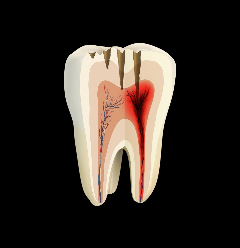 Gayang Station Dental Clinic: Sensitive to Cold Water, Throbbing with Hot Soup! Is It Okay to Leave It This Way? image 8