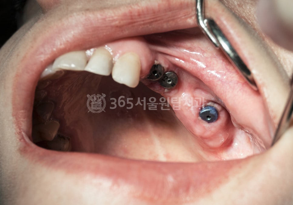 등촌역임플란트치과 수술 후 비행기 타도 괜찮을까? 관련 이미지 4