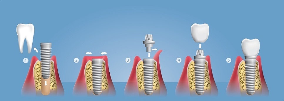 송정역치과, 임플란트 수술 후 술 담배가 문제되는 이유 관련 이미지 4