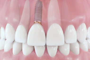 화곡역치과 치아가 빠진 개수만큼 임플란트를 심어야 될까? 관련 이미지 6