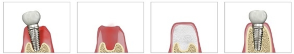 강서구청치과 임플란트 오래 쓰려면 피해야할 이것 관련 이미지 5