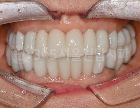 화곡동임플란트, 수술 전 CT에서 꼭 확인해야하는 3가지 관련 이미지 6