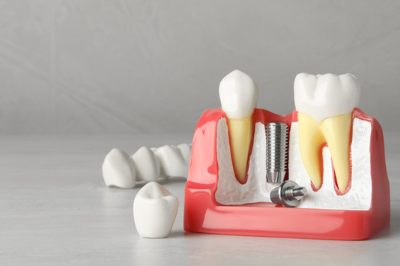 신월동치과 임플란트 심는 자리만 보면 안 되는 이유 관련 이미지 12