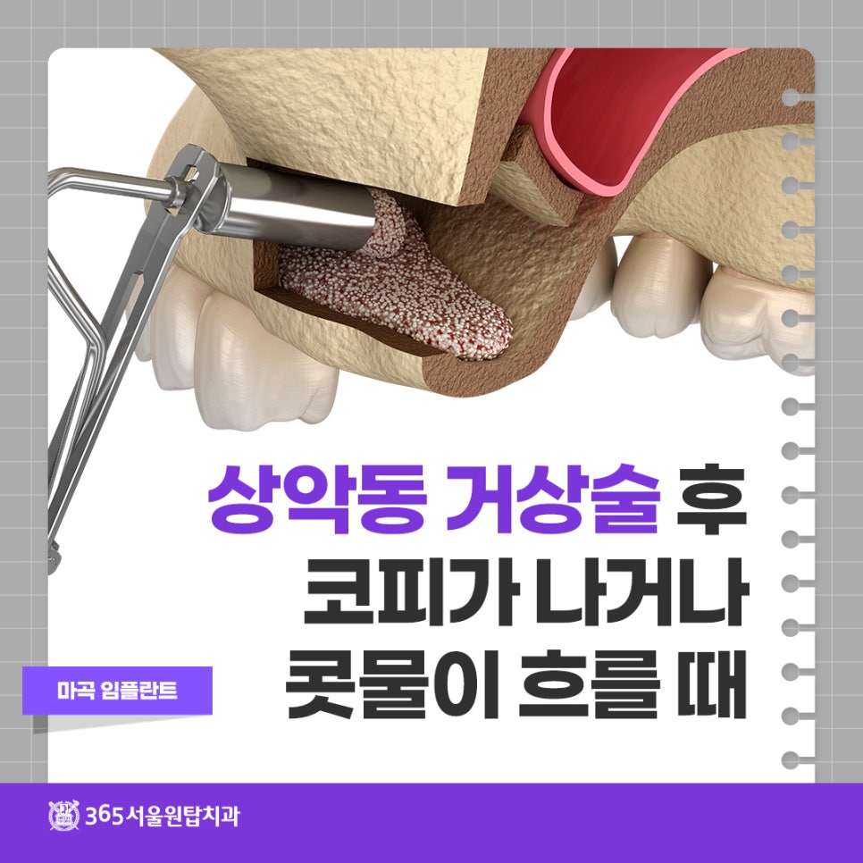 마곡임플란트, 상악동 거상술 후 코피가 나거나 콧물이 흐를 때 관련 이미지 9
