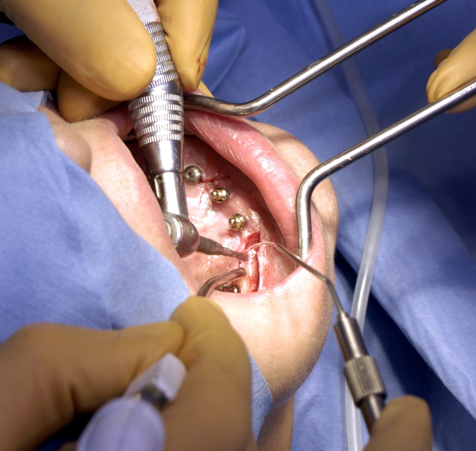 방화역치과, 임플란트 수술 시 열발생을 줄여야 하는 이유 관련 이미지 4