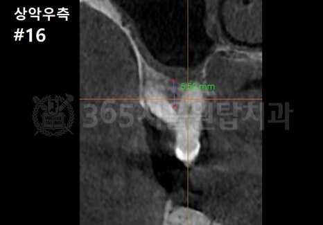 염창역 임플란트, 식립 각도의 차이가 치료 결과를 좌우합니다 관련 이미지 5
