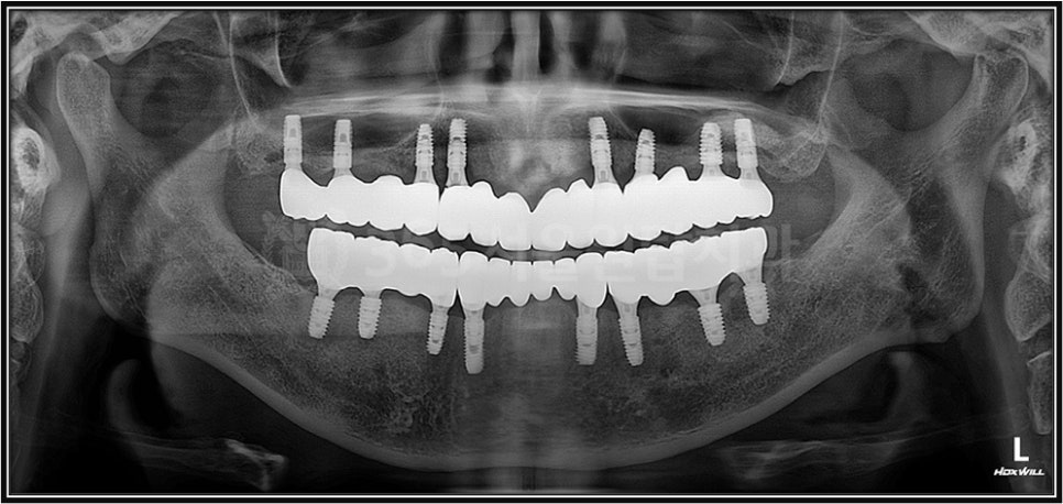 염창역 임플란트, 식립 각도의 차이가 치료 결과를 좌우합니다 관련 이미지 7