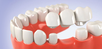 화곡역치과 치아가 빠진 개수만큼 임플란트를 심어야 될까? 관련 이미지 11