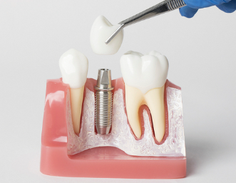 화곡역치과 치아가 빠진 개수만큼 임플란트를 심어야 될까? 관련 이미지 12