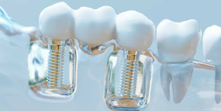 신월동치과 임플란트 심는 자리만 보면 안 되는 이유 관련 이미지 3