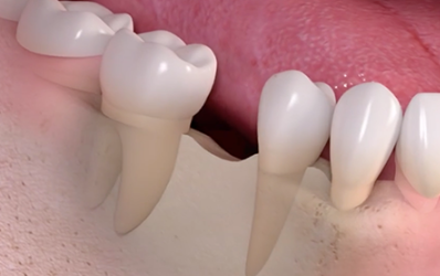 화곡역치과 치아가 빠진 개수만큼 임플란트를 심어야 될까? 관련 이미지 1