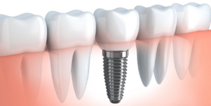 화곡역치과 치아가 빠진 개수만큼 임플란트를 심어야 될까? 관련 이미지 4