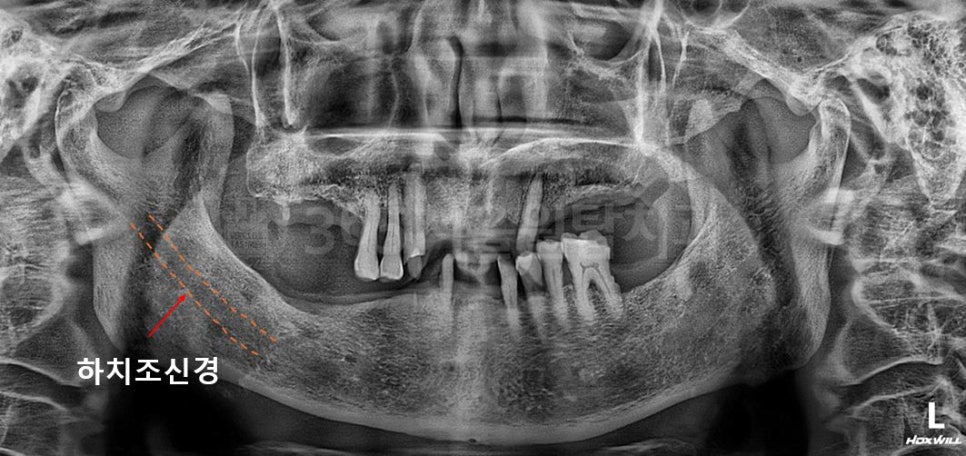 Balsan Station Dental Clinic: What If the Anesthesia Doesn’t Wear Off After Implant Surgery? image 5